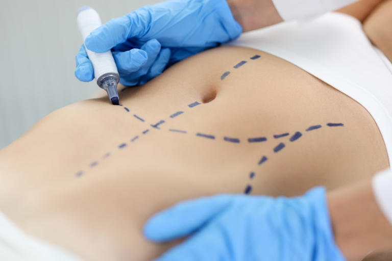 Abdominoplastia en Nicaragua