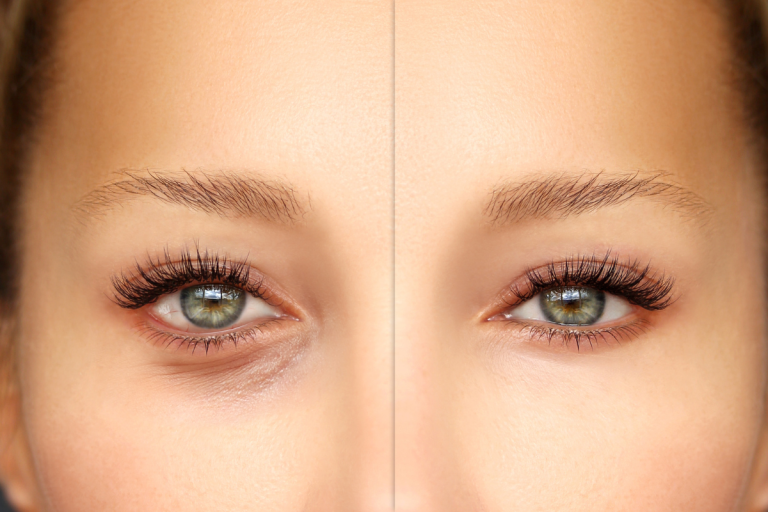 Blefaroplastia en Nicaragua