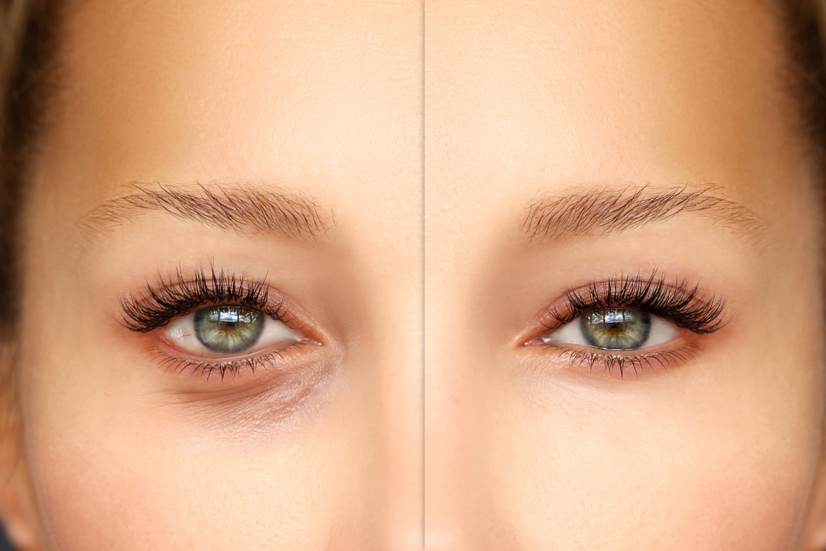 Blefaroplastia en Nicaragua