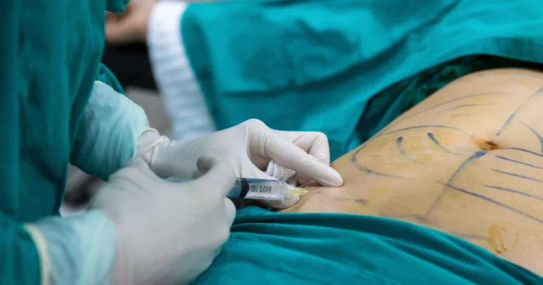 ¿Cuándo es necesaria la combinación_ (Lipoabdominoplastia)